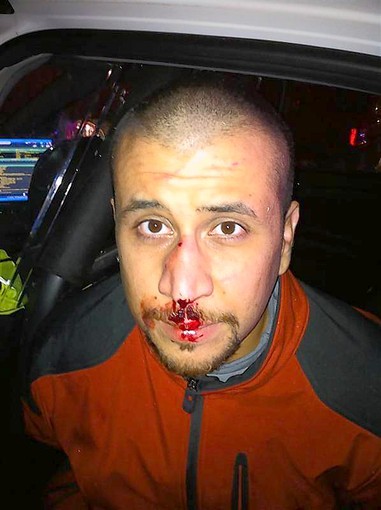 George Zimmerman bloody nose