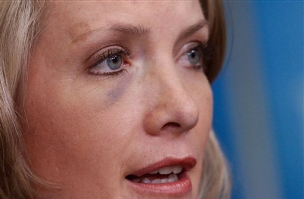 White House Press Secretary Dana Perino, sporting a black eye from the scuffle in Iraq during the shoe throwing incident over the weekend, responds to a reporters question, Tuesday, Dec. 16, 2008, during her daily briefing at the White House in Washington.  (AP Photo)