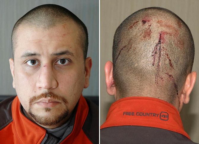 Trayvon Martin Case: Looking at the Just-Released "Bloodied Zimmerman" Photos