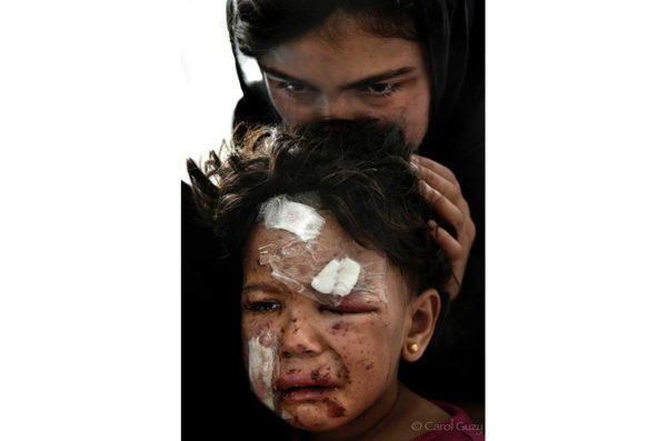 Tiny battered face of 4 year old child named Noor who escaped with her mother during fighting with ISIS is treated at trauma field hospital operated by Aspen Medical and World Health Organization 15 kilometers from the front lines of west Mosul, Iraq on May 19, 2017. She sustained shrapnel wounds and injuries after their home collapsed and is comforted by a family member who wept when she saw her. The center provides emergency triage, surgery, X-ray capability, obstetrics and life-saving medical support for civilian casualties of the conflict with ISIS. Photo: Carol Guzy/Freelance/ZUMA Press Photo